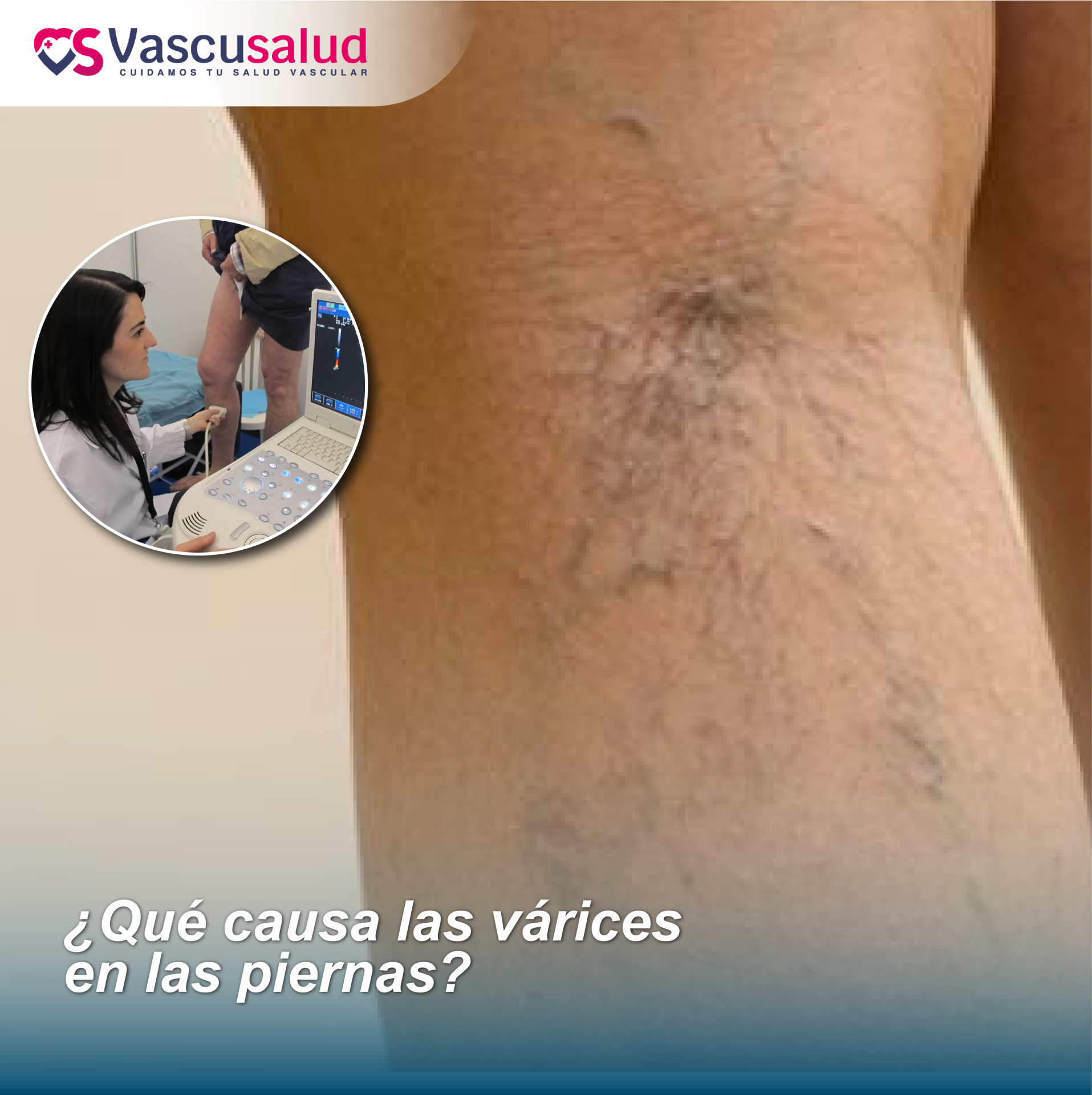 Qué causa las várices en las piernas