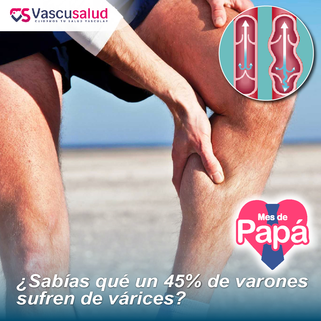 sabías qué un 45% de varones sufren de varices